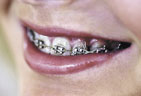 Orthodontic brackets bonded